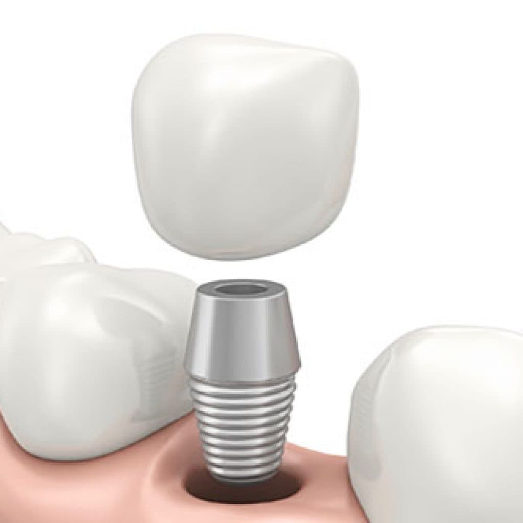 Detailed Illustration of Dental Implants | Dental Implants in West Liberty, IA, North Liberty, IA and Muscatine, IA | Gentle Family Dentists