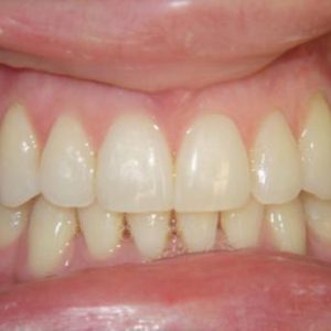 Misaligned Teeth in Lower Front After Treatment | West Liberty, IA | Gentle Family Dentists