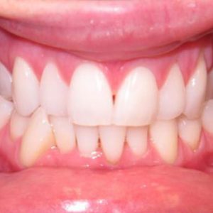 Misaligned Teeth in Lower Front Before Treatment | West Liberty, IA | Gentle Family Dentists