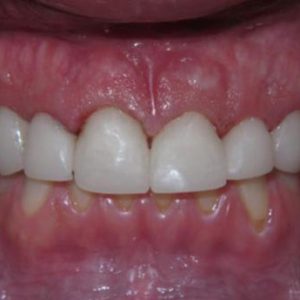 Teeth with Cavities and Plaque After Treatment | West Liberty, IA | Gentle Family Dentists