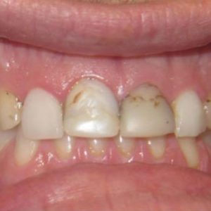 Teeth with Cavities and Plaque Before Treatment | West Liberty, IA | Gentle Family Dentists