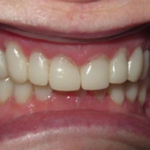 Grinded Teeth Restored After Treatment | West Liberty, IA | Gentle Family Dentists