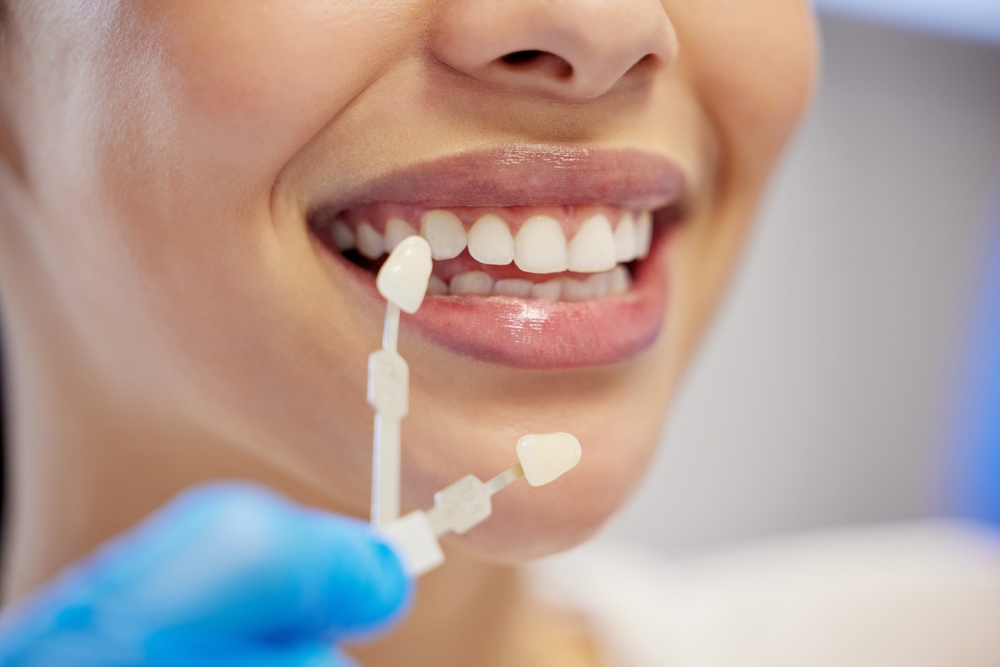 Dental Veneers West Liberty