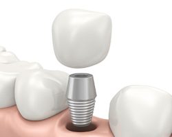 Detailed Illustration of Dental Implants | Dental Implants in West Liberty, IA, North Liberty, IA and Muscatine, IA | Gentle Family Dentists